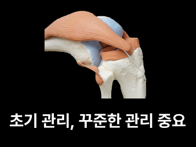 보스웰리아 관절 건강에 주목받는 이유
