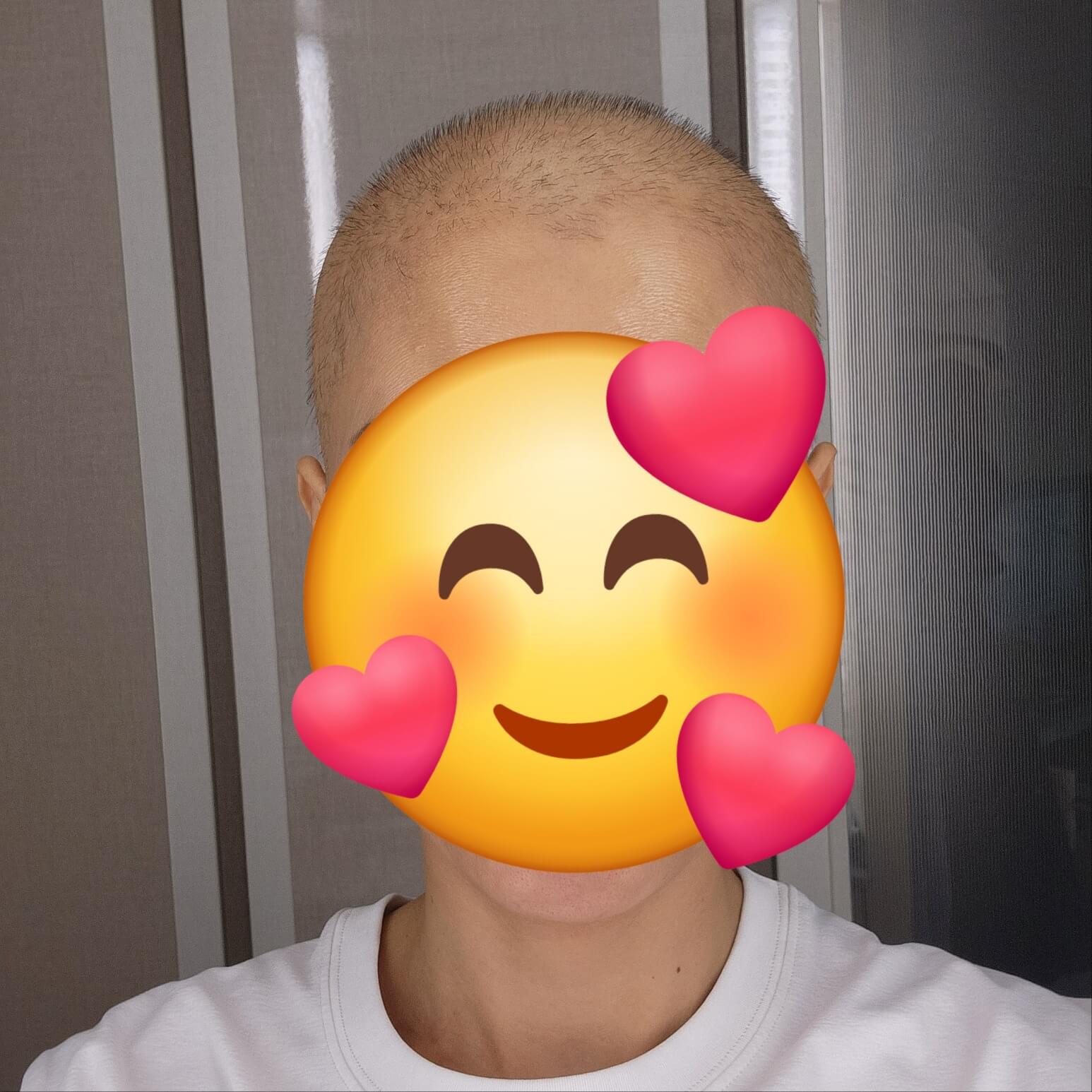 항암 부작용으로 머리 빠진 뒤 처음 머리 올라온 사진