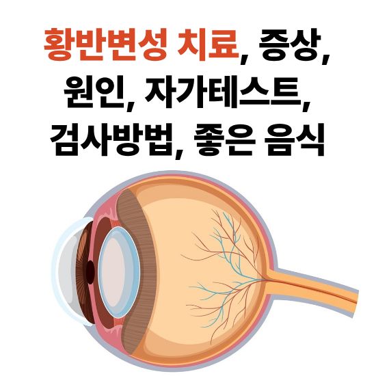 황반변성 치료, 증상, 원인, 자가테스트, 검사, 좋은 음식